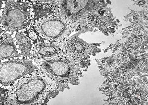 F, 1y. | epidermolysis bullosa … dystrophic form F, 1y. | epidermolysis bullosa … dystrophic form